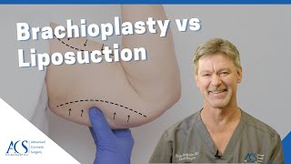 Brachioplasty Arm Lift Surgery Vs Liposuction Explained By Plastic Surgeon Dr Tom McFadden [upl. by Blaire]