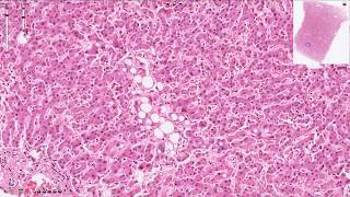 Hepatic Steatosis  Histopathology  Normal Liver Histology [upl. by Lertnom]