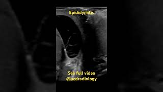 Epididymitis radiologist radiology ultrasound medicine medicalschool [upl. by Theodore]