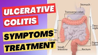 Ulcerative Colitis  Inflammatory Bowel Disease  Symptoms Diagnosis and Treatment [upl. by Arada]