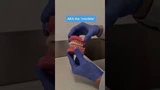 Do you have a Normal Bite or an Overbite or Underbite braces underbite overbite [upl. by Akehs]