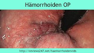 Hämorrhoiden ohne OP loswerden [upl. by Maurits]