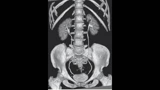 CT Urography  Post Processed urology ct radiology xray shorts video viralvideo trending [upl. by Cherrita]