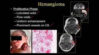 Simplified Approach to Craniofacial Vascular Malformations [upl. by Anetta]