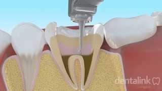 Endodoncia completa PASO A PASO  Video 3D [upl. by Aes]