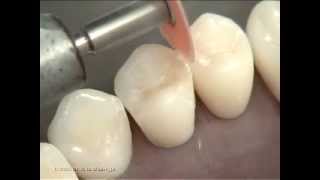 Composite Class II Preparation and Restoration on Premolar [upl. by Ttenneb]