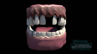 3d Animation On The Affects of Pyorrhea  Receding Gums and Tooth Loss  NYC Dentist Can Help [upl. by Pelmas485]