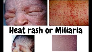 Heat rash Miliaria or Miliariapimples and rash due to heat or warmthDermatology lecture for MBBS [upl. by Chassin581]