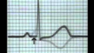 Learning ECG  WPW Syndrome [upl. by Roman]