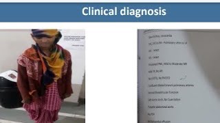 Sydenham Chorea  Spot Diagnosis  14  Pediatrics [upl. by Bakki]