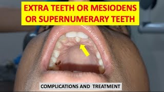 SUPERNUMERARY TEETH MESIODENS EXTRA TEETH COMPLICATIONS AND TREATMENT dentalcafe4331 [upl. by Ariajay878]