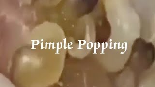 Pimples amp Blackheads Popping  37 [upl. by Ehpotsirhc]