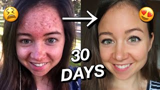 HOW I CLEARED MY SKIN NATURALLY ☁️💫 30 day transformation [upl. by Neltiac]