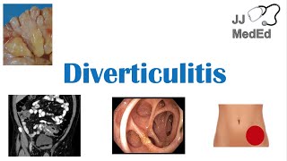 Diverticulitis Risk Factors ex Low Fiber Diets Symptoms Diagnosis Treatment and Complications [upl. by Idnarb]