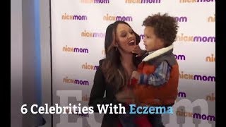 6 Celebrities With Eczema  Health [upl. by Adallard374]