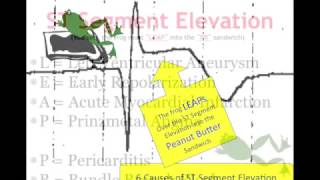 Teaching 12 Lead EKG STEMI or early repol [upl. by Oiluig18]