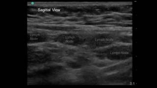 Mesenteric Adenitis in 7 yo Boy with Periumbilical Abdominal Pain and Vomiting [upl. by Pare]