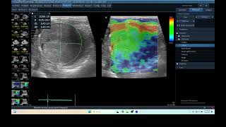 IQ 279 LIVER ULTRASOUND HEPATOMA ECHOPAC ANALYSIS ECHOCARDIOGRAPHY ELASTOGRAPHY [upl. by Drusy446]