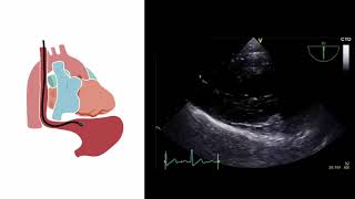 Mastering important TEE views transesophageal echocardiography [upl. by Zelma700]