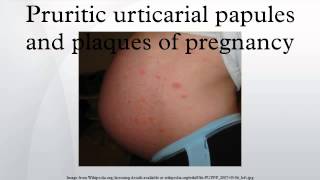 Pruritic urticarial papules and plaques of pregnancy [upl. by Eadwine]