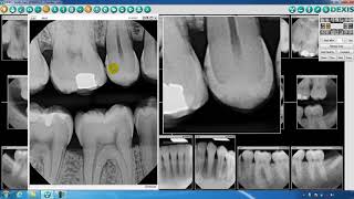 DEXIS™ Imaging Suite Toolbar Overview  Part Two [upl. by Tristram]