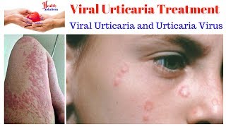 Viral Urticaria Treatment  Viral Urticaria and Urticaria Virus 😉 [upl. by Christal]