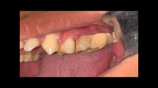 Deep Cleaning With HEAVY Tartar Build Up At The Dentist [upl. by Olbap]