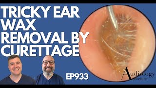 TRICKY EAR WAX REMOVAL BY CURETTAGE  EP933 [upl. by Cole]