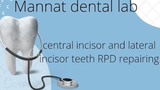 central incisor and lateral incisor teeth RPD repairing [upl. by Liebowitz]