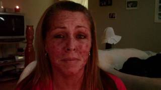 Skin Cancer My Vlogjournal Treatment W EFUDEX vid8 [upl. by Aryan215]