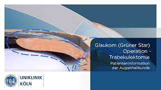 Glaukom Grüner Star OP  Trabekulektomie Patienteninformation Augenklinik  Uniklinik Köln [upl. by Wilone]