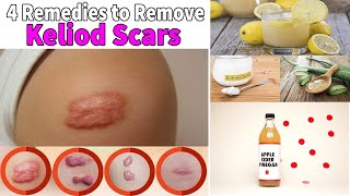 Keloid Scar Removal at Home 4 Remedies for Treatment of Scars [upl. by Benco]