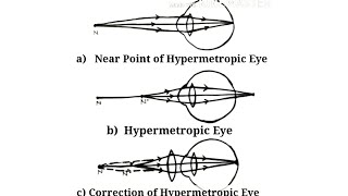 Hypermetropia eye correction diagram  hypermetropic eye correction correction of hypermetropic eye [upl. by Bowe]