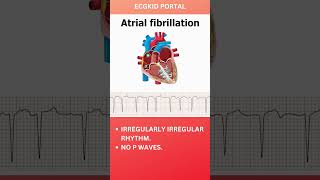 Atrial Fibrillation Anatomy ECG icu medicine emergencymedicine atrialfibrillation [upl. by Giarla]