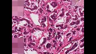 Histopathology LungBronchial carcinoid [upl. by Stutman30]