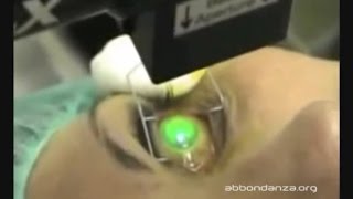 Corneal Collagen Crosslinking for keratoconus  Dr Marco Abbondanza [upl. by Eesak404]