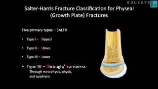 Salter Harris Fracture Classification for Growth Plate Fractures [upl. by Pelagias]