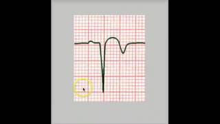 PATHOLOGIC Q WAVE [upl. by Fasa]