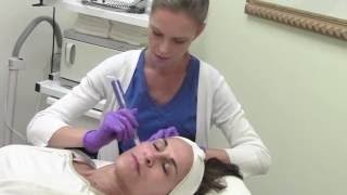 MicroNeedling Procedure Demo [upl. by Eniaral]