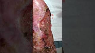 Venous stasis ulceration with pyoderma gangrenosum [upl. by Etnod736]