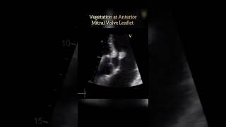 Vegetation at Mitral Valve echo shorts shortsvideo heartcondition [upl. by Ecnarrot]