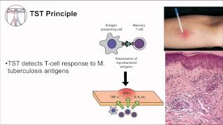 Tuberculosis Diagnosis [upl. by Keffer948]