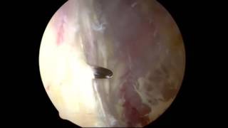 Iliotibial Band Tendinoplasty  ITB Release  ITB Plasty  Hip Surgeon [upl. by Herby]