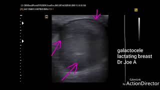 Galactocele lactating breast [upl. by Lund]