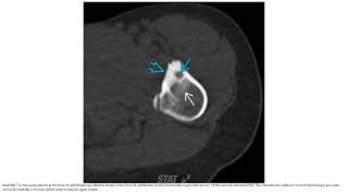 Osteoid Osteoma Imaging [upl. by Yak]