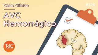 Caso Clínico de AVC Hemorrágico Episódio 126 [upl. by Nerual521]