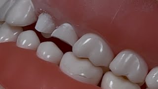 Crown and Bridge premolar preparation [upl. by Raseda]