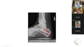 Insertional Achilles tendinosis The Zadek Osteotomy  preop planning and step by step resection [upl. by Bronwen]