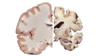 Alzheimers and the Brain [upl. by Hepzi]