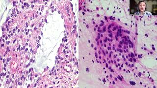 Tip31Pilocyticastrocytoma of an Adult [upl. by Anaili]